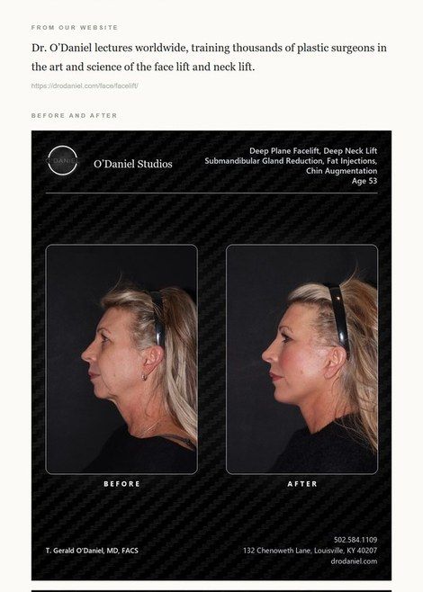 Facelift email with the practice's facelift cases