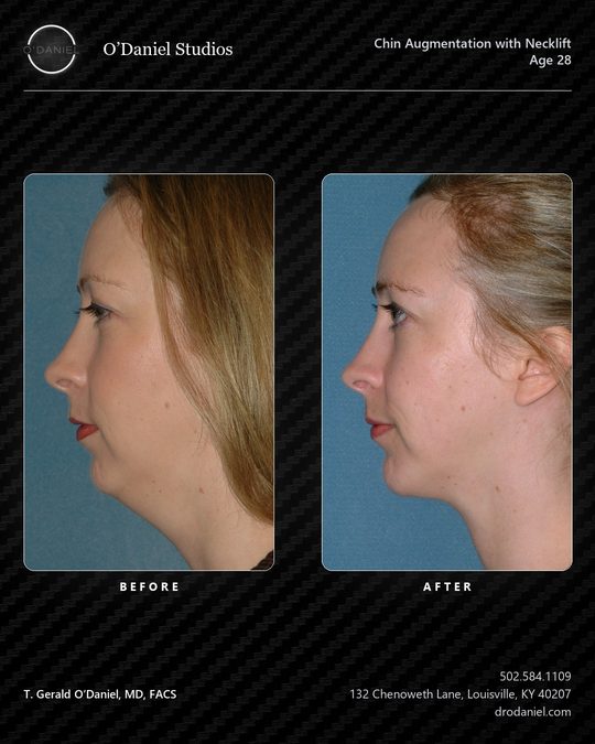 Chin augmentation case slide