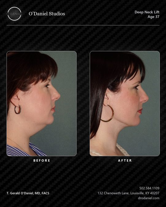 Deep neck lift case slide