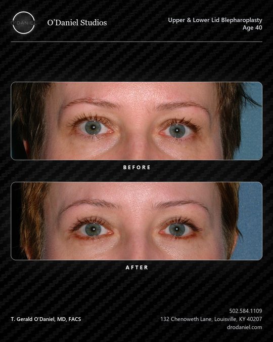 Eyelid case slide