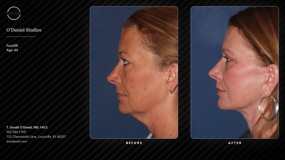 Facelift case slide, 16:9