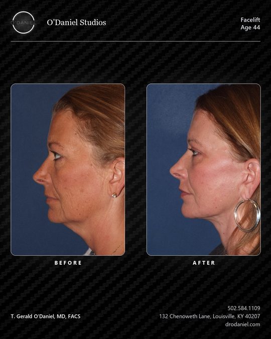 Facelift case slide, 4:5