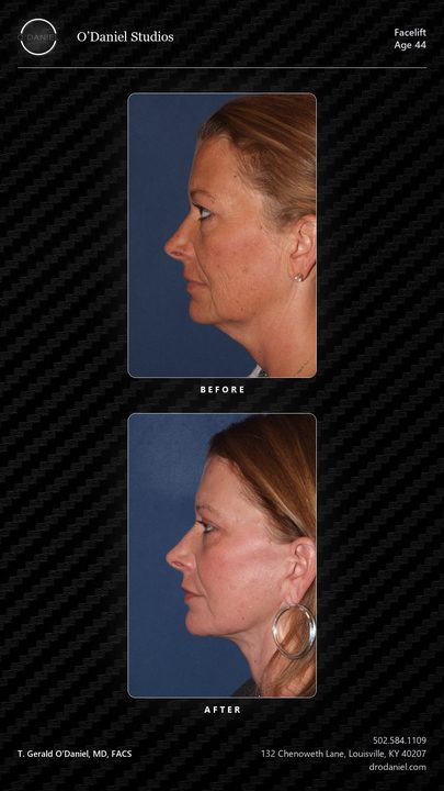 Facelift case slide, 9:16