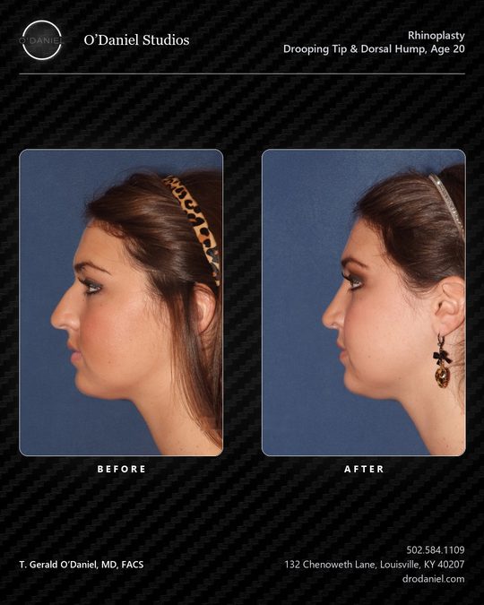 Rhinoplasty case slide