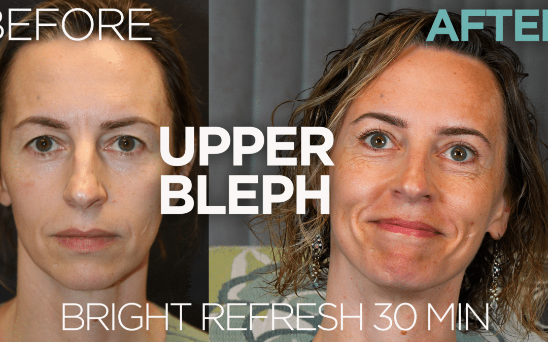 Case Study – Dr. Scott Holley 2024 Blepharoplasties – Real Patient Stories