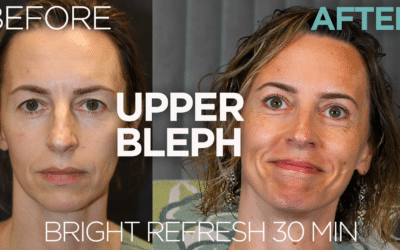 Case Study – Dr. Scott Holley 2024 Blepharoplasties – Real Patient Stories